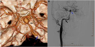 A Persistent Primitive Hypoglossal Artery As the Sole Supply to the Brain Associated with a Basilar Bifurcation Aneurysm